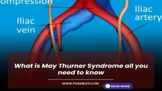 What is May Thurner Syndrome all you need to know