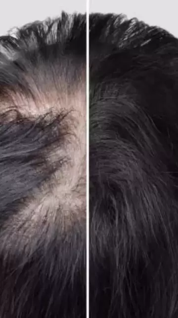 How to massage bald spots Picture