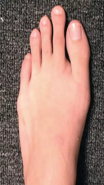 Toe Hair Loss Warning Signs Picture